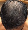 13 months after transplant, damp hair.jpg