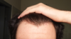 hairline_front.png