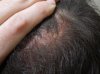 crown thick hair follicle neogenesys proof.jpg crown thick hair follicle neogenesys proof.jpg