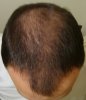 3 weeks in hair length 1 month post buzz with high grade.BASELINE..jpg