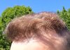 9 mesi hair transplant  (5).jpg