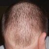diffuse-patterned-alopecia.jpg