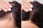 Hair-Loss-Treatment.jpg Hair-Loss-Treatment.jpg