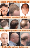 male-pattern-baldness.png