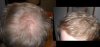 2 months on Finasteride.jpg 2 months on Finasteride.jpg