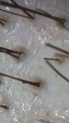 Hair Follicles.jpg