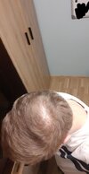 hairloss 5.jpg