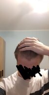 hairloss 1.jpg