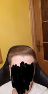 hairloss 6.5.jpg