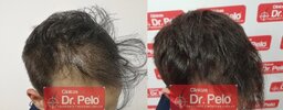 tratamiento-capilar-fue-en-dr-pelo-22-1.jpg