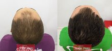 tratamiento-capilar-mesoterapia-ledhair-22.jpg