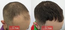 tratamiento-capilar-mesoterapia-ledhair-23.jpg