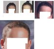 Hairline choice033.jpg