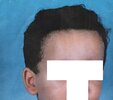 Hairline choice035.jpg