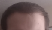 hairline.png