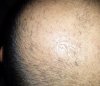 1 week post minoxidil.jpg 1 week post minoxidil.jpg