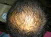 3 month finasteride and Min.jpg 3 month finasteride and Min.jpg