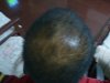 3 month Minoxidil.jpg 3 month Minoxidil.jpg