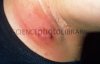 M1080372-Close-up_of_an_axillary_abscess_on_armpit_-SPL.jpg