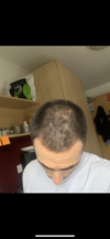 september 2019 (1 year minoxidil monotherahy and beginning of finesteride 1mg).PNG