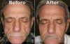 before-after-lipoatrophy1.jpg