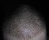 HAIR LINE 2 WEEK POST OP.jpg