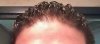 Scalp-Hairline.jpg