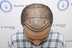 hair line marking.JPG