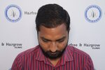 6 Month hair transplant result.jpg