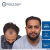 3772-grafts-fue-hair-transplant-4-month-result-pune-india.jpg.jpg