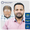 abhishek-rajamne-hair-transplant-result-pune-india-3012-grafts-big-fue-14-months.jpg.jpg