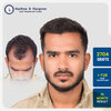arbaz-khokar-hair-transplant-result-india-2704-grafts-i-fue-10-month.jpg.jpg