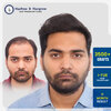 karan-agarwal-hair-transplant-result-pune-3500-grafts-i-fue-11-month.jpg.jpg