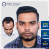 2710-grafts-dht-hair-transplant-10-month-result-pune.jpg.jpg