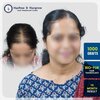 Blur_rohini-kandalgaokar-1000-grafts-bio-fue-hair-transplant-14-month-result-pune.jpg.jpg