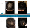 i-interviewed-kintor-gt20029-clinical-trial-pictures-as-v0-bapry9aw8x8e1.jpg