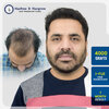 shrinivas-katekar-4000-grafts-i-fue-hair-transplant-7-month-result-pune.jpg.jpg
