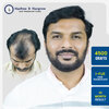 swapnil-badnale-4500-grafts-i-fue-hair-transplant-10-month-result-pune.jpg.jpg