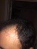 left Hairline after.jpg left Hairline after.jpg