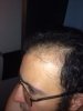 Left Hairline- before.jpg Left Hairline- before.jpg