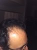 right Hairline before.jpg right Hairline before.jpg