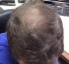 hairloss2.jpg