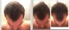 Hair loss 1-3 mos.jpg Hair loss 1-3 mos.jpg