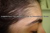 HIPERTRICOSIS%u00252BPOR%2BMINOXIDIL.%2BAURORA%2BGUERRA.JPG
