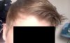 pre-transition hairline 2.jpg pre-transition hairline 2.jpg