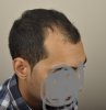 hair transplant 3.jpg hair transplant 3.jpg