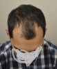 hair transplant 2.jpg hair transplant 2.jpg