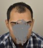 hair transplant 1.jpg hair transplant 1.jpg