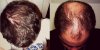 hair-transplant-before-after-photographs1.jpg hair-transplant-before-after-photographs1.jpg