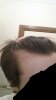 hairloss2.jpg